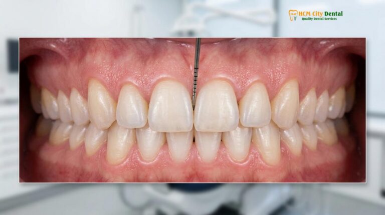 Gum Contouring Pain: Clinical Recovery Guide & Management