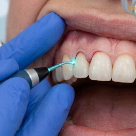 Gum Contouring Recovery: Clinical Healing Timeline & Care Guide