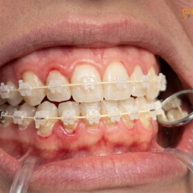 Gum Disease Braces: Clinical Management & Prevention | HCMC Dental