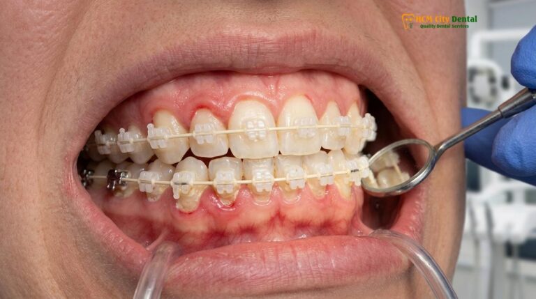 Gum Disease Braces: Clinical Management & Prevention | HCMC Dental