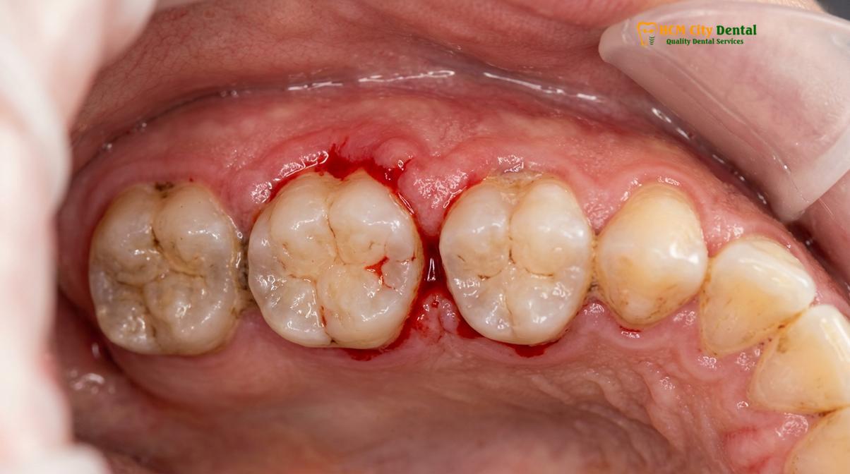 Clinical photography related to gum disease heart disease