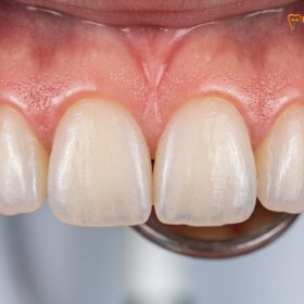 Gingival Zenith Points: Clinical Anatomy & Laser Contouring Guide