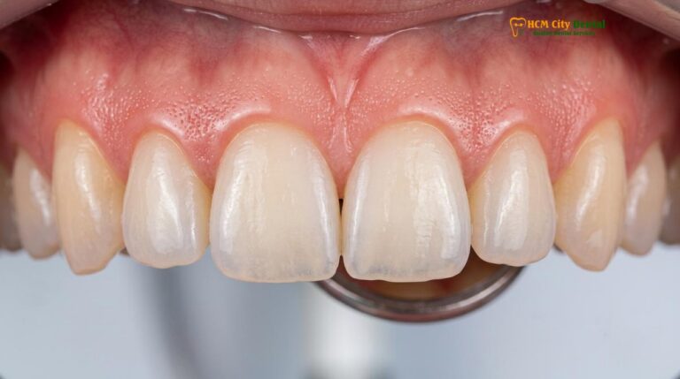 Gingival Zenith Points: Clinical Anatomy & Laser Contouring Guide