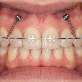 Gummy Smile Braces in Vietnam: Clinical Orthodontic & Laser Solutions