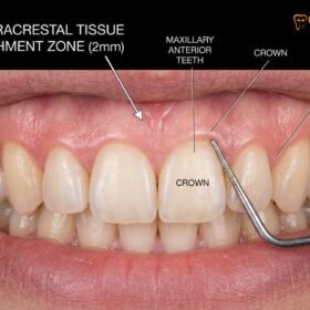 Gummy Smile Insurance Vietnam: Claims, Costs & Clinical Guide