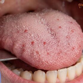 Halitosis: Clinical Causes, Diagnostics & Treatment | HCMC Dental