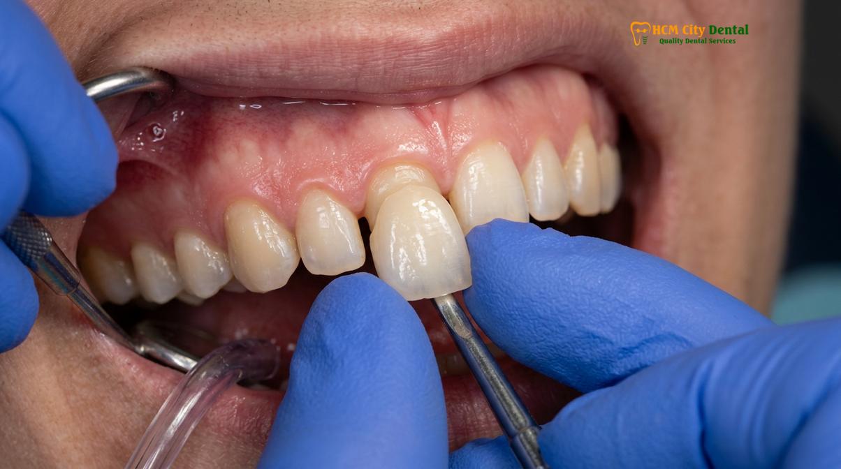 Visual description of hidden costs dental crowns vietnam