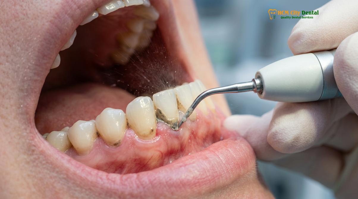 Visual description of Hidden Costs Orthodontics Vietnam