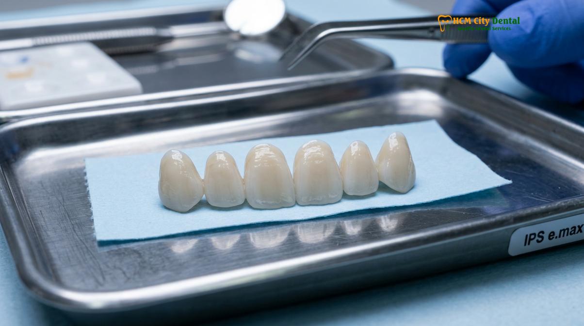 Clinical photography related to hidden costs veneers vietnam