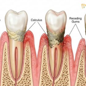 Dental Calculus & Gum Recession: Clinical Pathologies & Removal