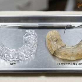 How Long Night Guard Last Lifespan: Clinical Guide | HCMC Dental