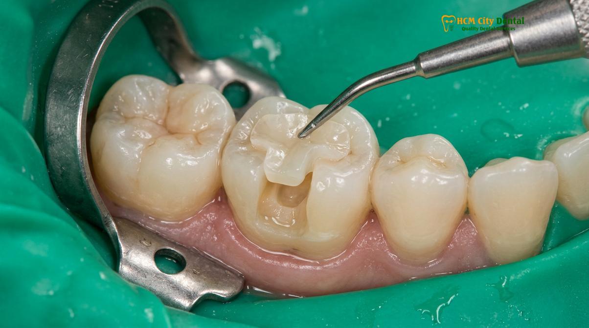 Visual description of how long do porcelain inlays last