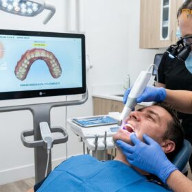 How Long Do Veneers Last? Clinical Lifespan & Maintenance Guide