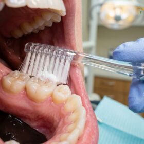 How Long Should You Brush Your Teeth? Clinical Guide | HCMC Dental