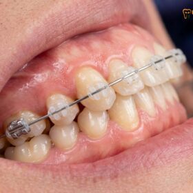 How Long to Wear Braces? Unlock Your Perfect Smile Fast | Dr. Cuong