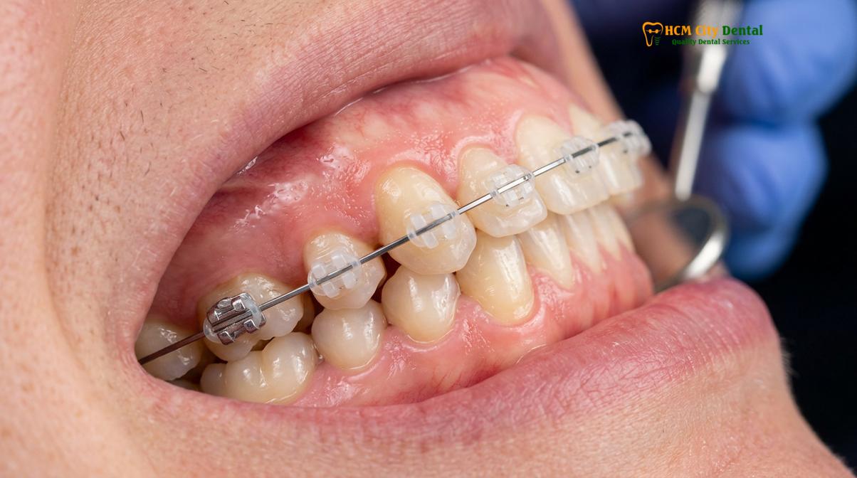 Clinical illustration of how long do you have to wear braces