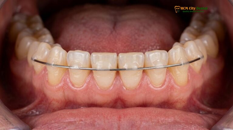 How Long to Wear Retainers After Braces: Clinical Guide | HCMC Dental
