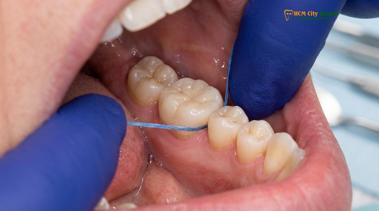 Visual description of how to clean dental onlays