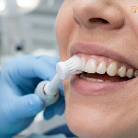 How to Clean Veneers: Clinical Guide to Maintenance & Longevity