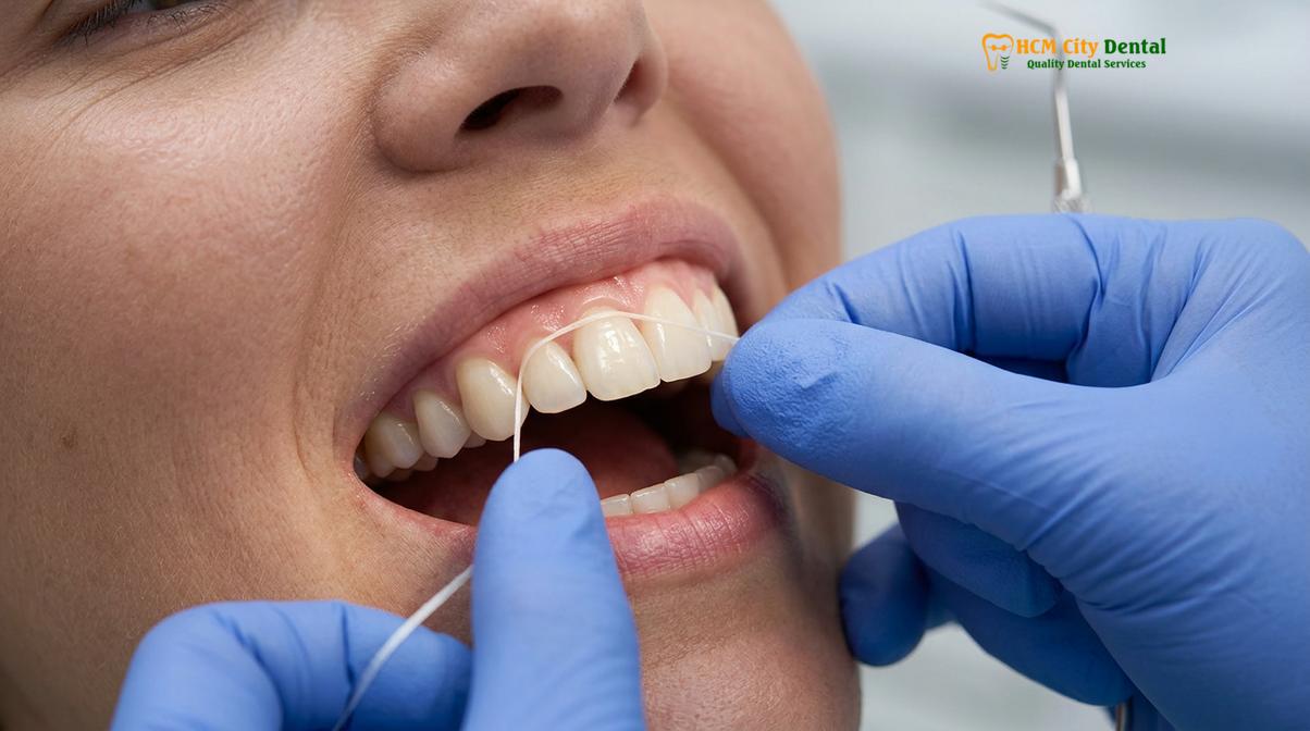 Visual description of how to clean veneers