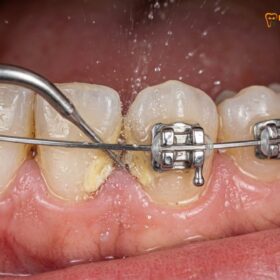 Clean Teeth With Braces Professional Guide: Clinical Protocols