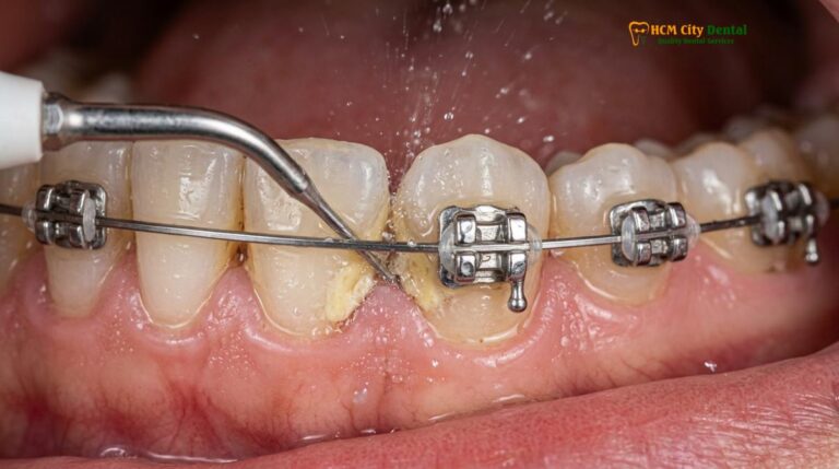 Clean Teeth With Braces Professional Guide: Clinical Protocols