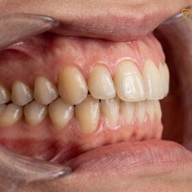 Buck Teeth Braces: Clinical Overjet Correction | HCMC Dental