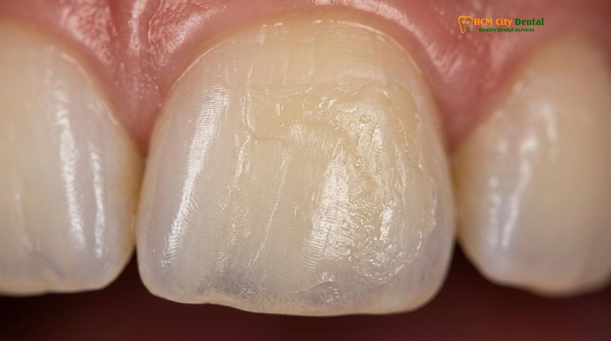 Clinical photography related to how to remove braces from teeth at home
