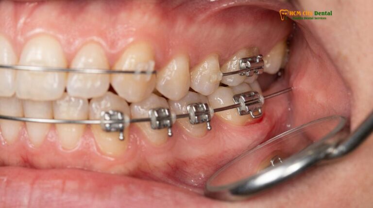 How to Stop Braces Wire Poking Cheek: Clinical Guide | HCMC Dental