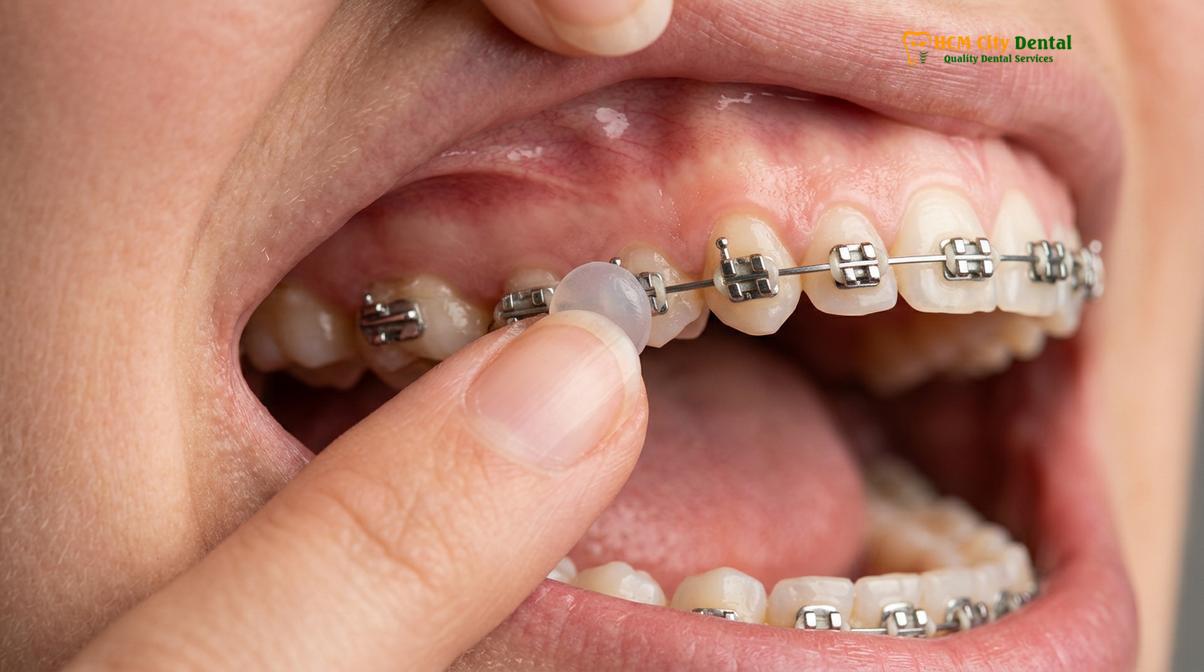 Clinical photography related to How to Stop Braces Wire Poking Cheek