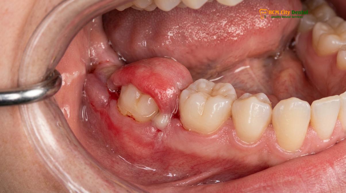 Clinical photography related to impacted wisdom tooth symptoms