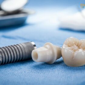 Screw vs Cement Retained Implant Crown: Clinical Guide | HCMC Dental