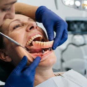 Implant Supported Overdenture HCMC | Snap-On Teeth Guide