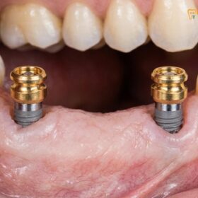 Implant Supported Overdentures Snap On: Clinical Guide