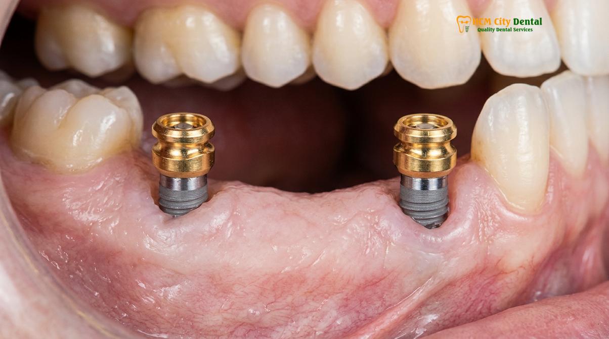 Clinical illustration of implant supported overdentures snap on