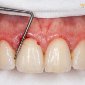 The Link Between Dental Health and Heart Attacks | HCMC Dental