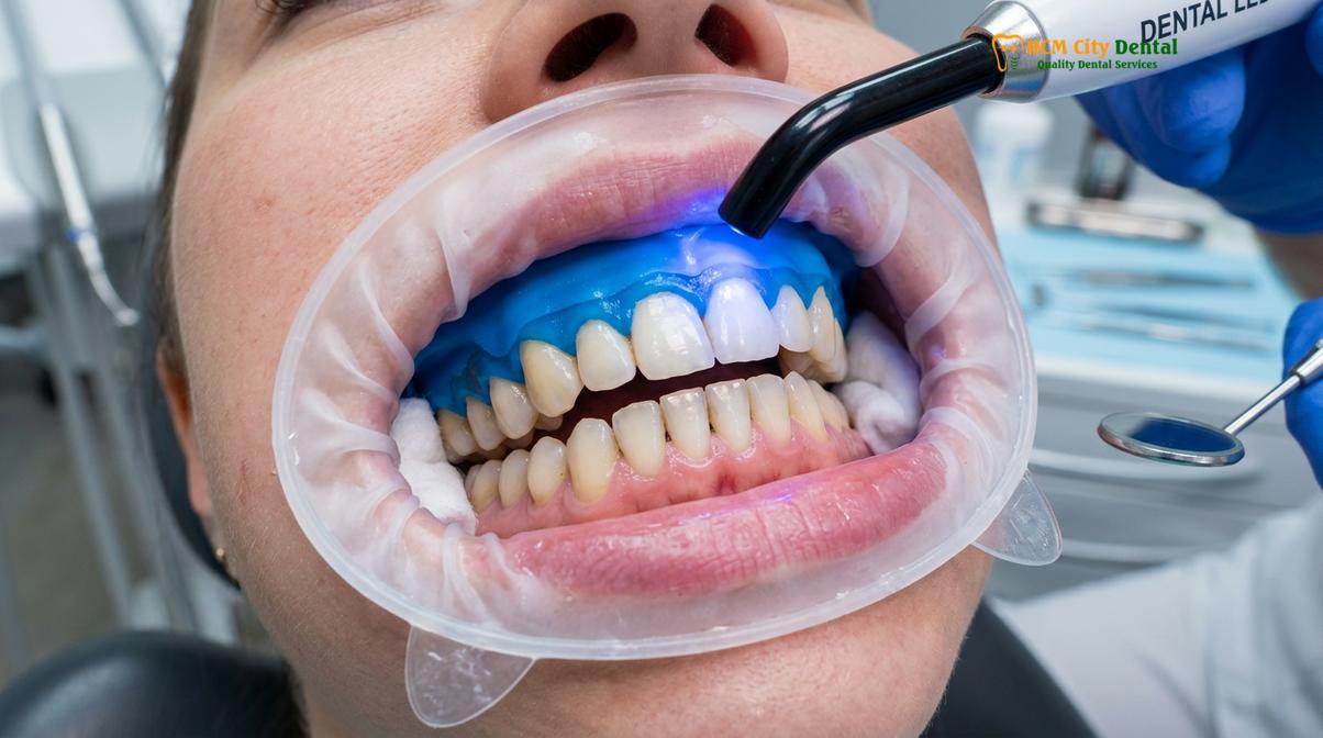 Clinical photography related to in-office vs at-home whitening vietnam