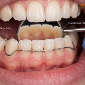 Inexpensive Braces for Adults: Clinical Guide & Costs | HCMC Dental