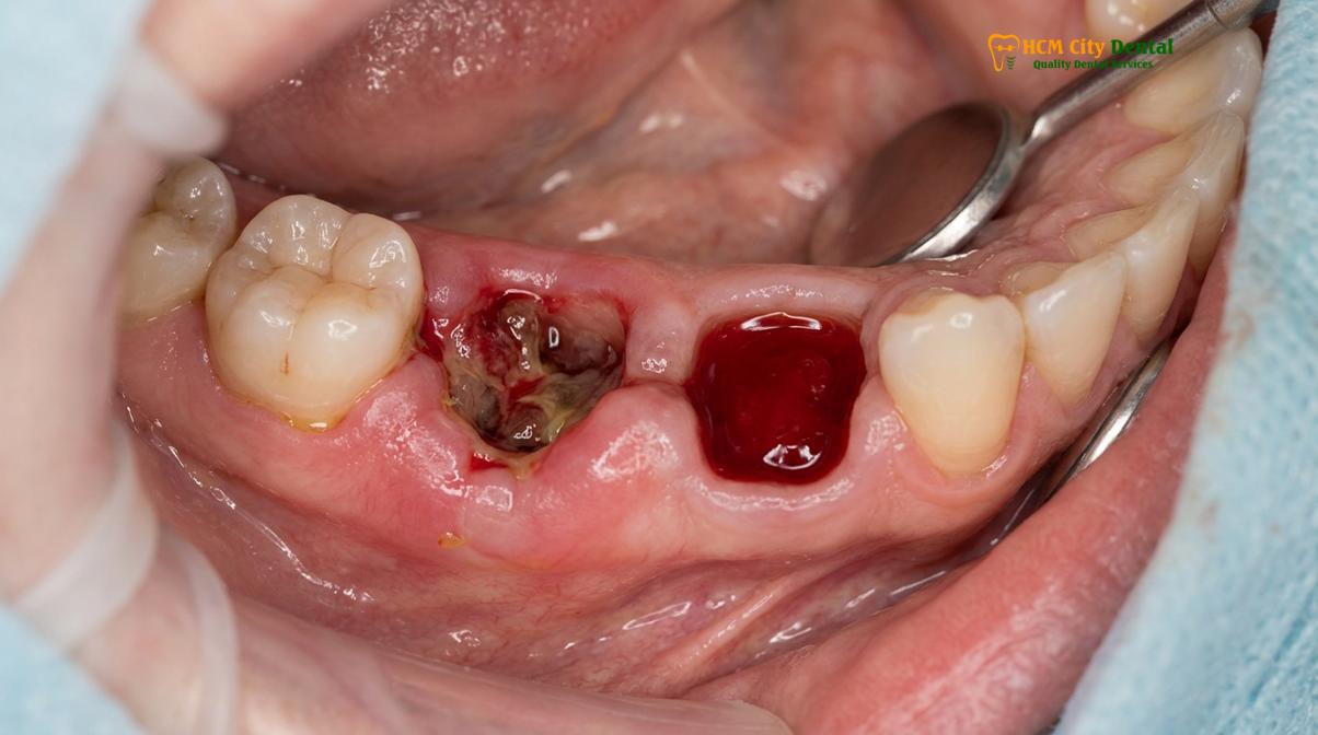 Clinical photography related to infection after wisdom tooth removal