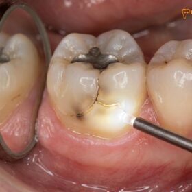 Cracked Tooth Inlay & Onlay: Clinical Guide to Restoring Fractured Cusps