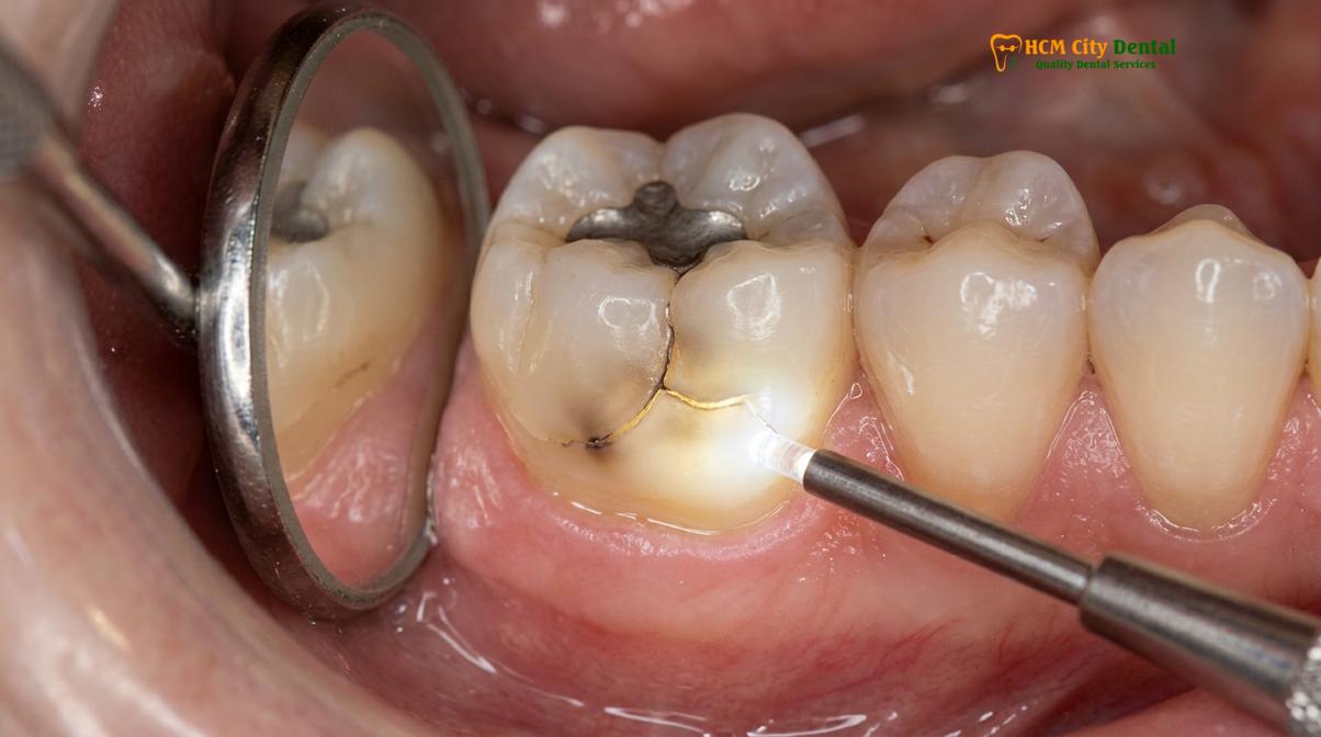 Clinical illustration of cracked tooth inlay onlay