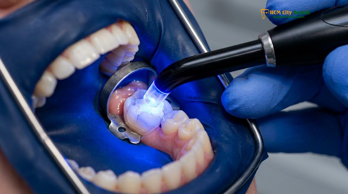 Clinical illustration of inlay onlay vs filling