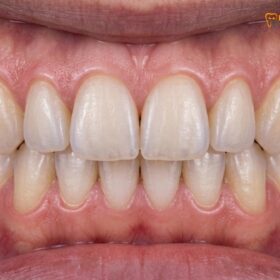 Inlay vs Veneer Front Teeth: Clinical Comparison & Guide