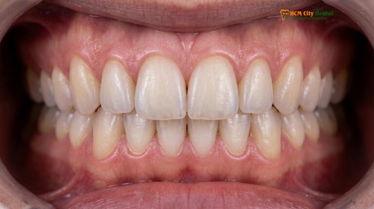 Inlay vs Veneer Front Teeth: Clinical Comparison & Guide