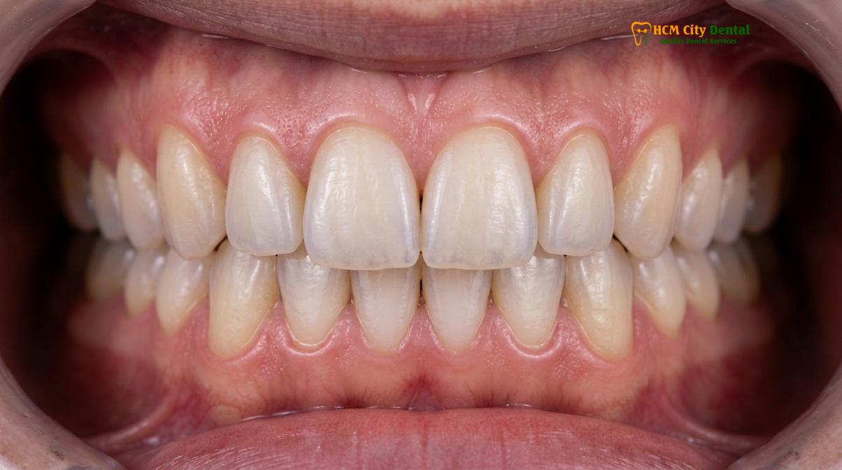 Clinical illustration of inlay vs veneer front teeth