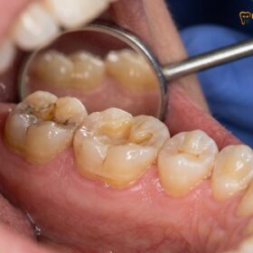 Night Grinding Onlay Protection: Clinical Protocols for Bruxism
