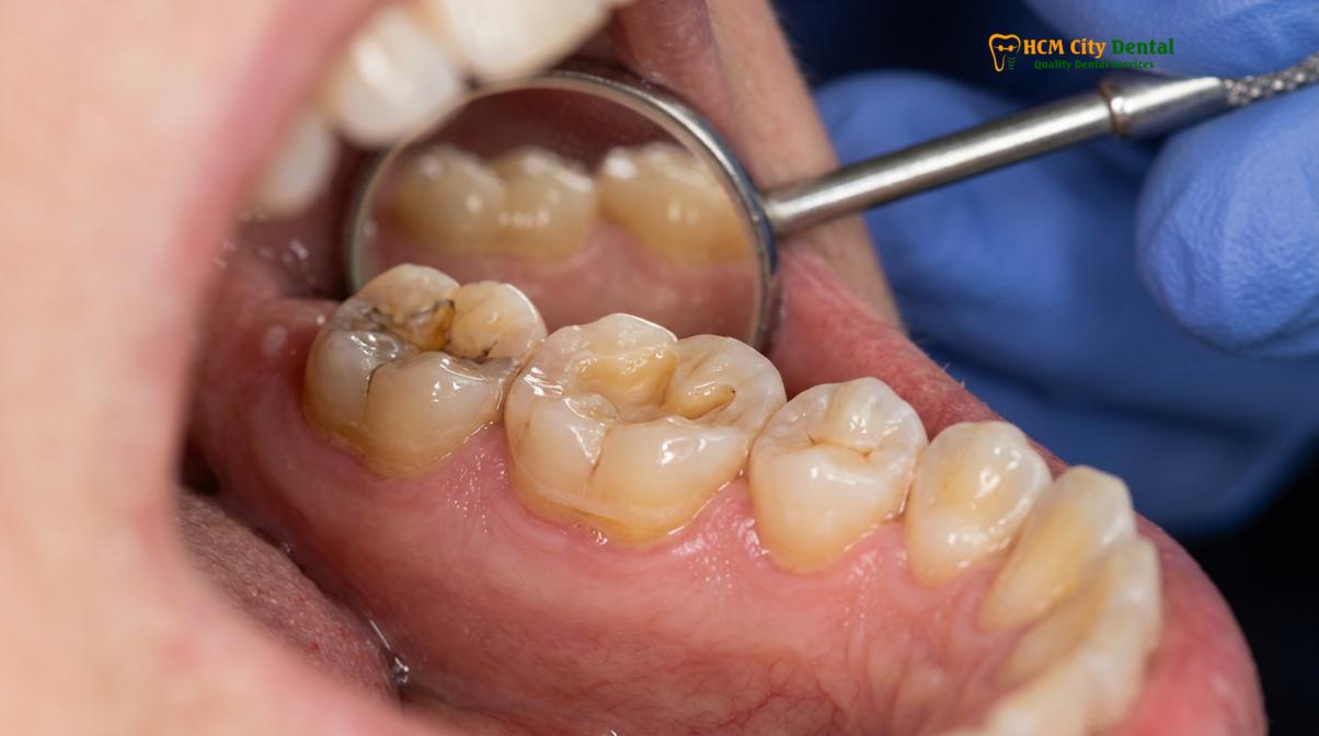 Clinical illustration of night grinding onlay protection