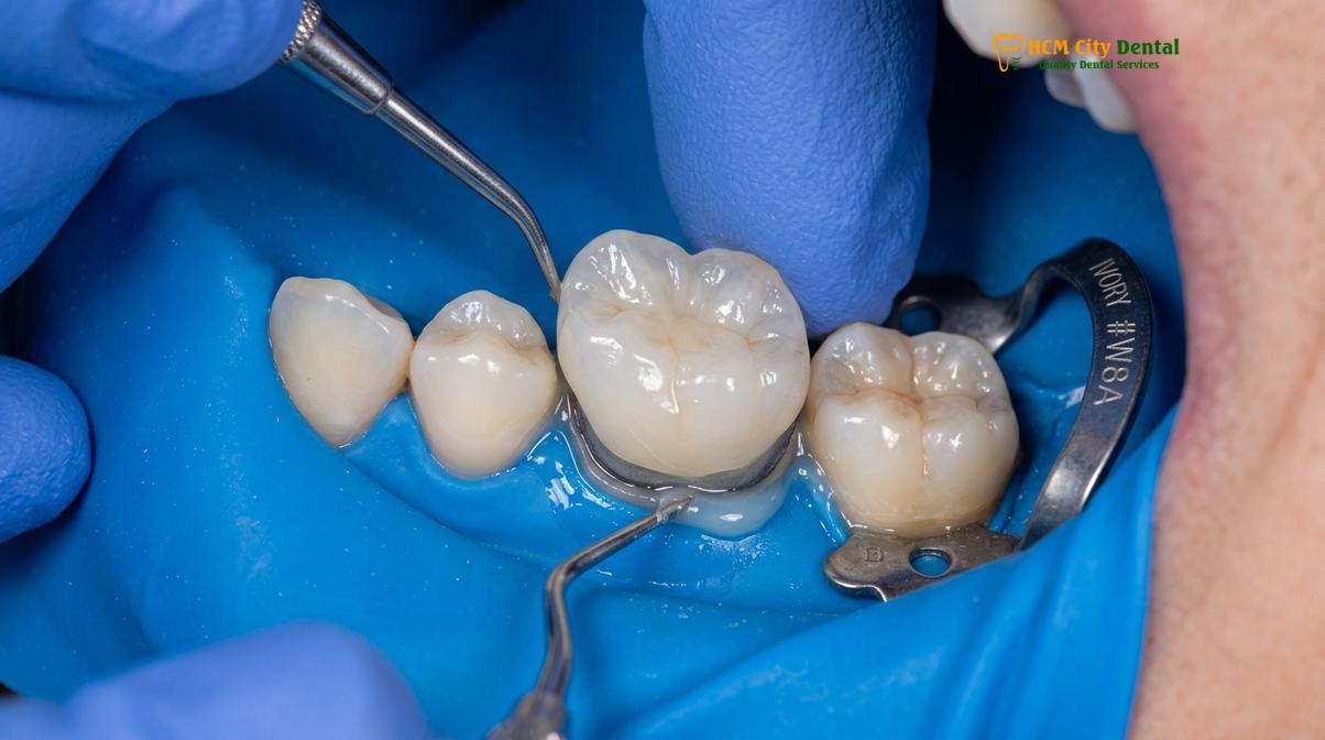 Visual description of dental financing inlays onlays