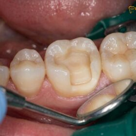 Inlays, Onlays vs Dental Crowns: Clinical Comparison & Guide