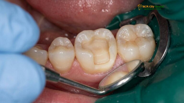 Inlays, Onlays vs Dental Crowns: Clinical Comparison & Guide